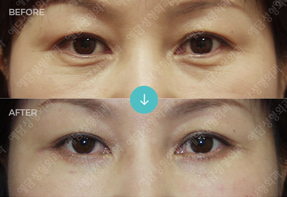 하안검 재수술 1개월 후 