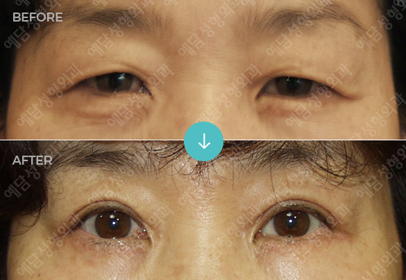 상안검 성형 1개월 후 