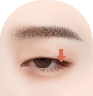 졸린 눈 안검하수