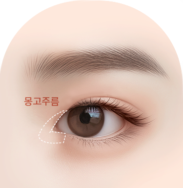몽고주름