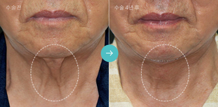 늘어진 목주름 + 변형된 목선 개선 